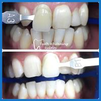 Teeth Whitening Sydney image 6